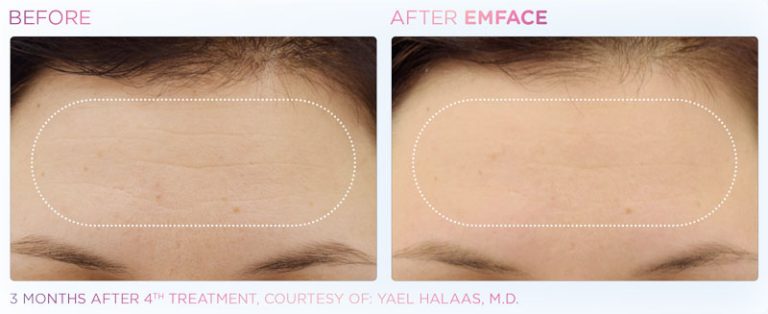 EMFACE Before and After | Facial Toning | Rizzo Family Medicine