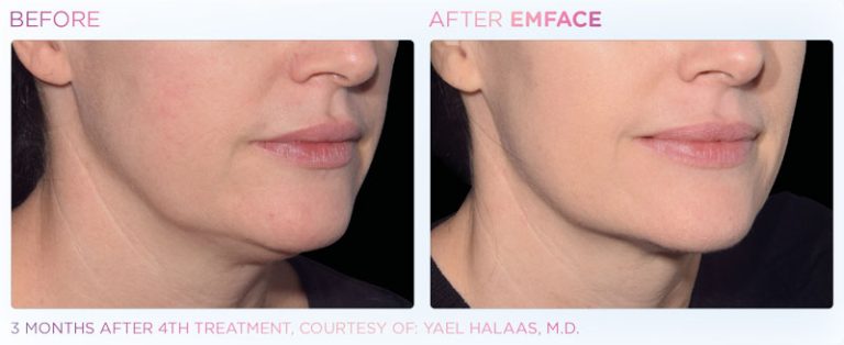 EMFACE Before and After | Facial Toning | Rizzo Family Medicine