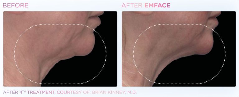 EMFACE Before and After | Facial Toning | Rizzo Family Medicine